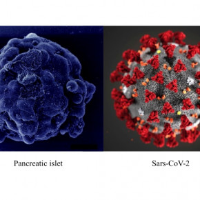 COVID-19 e vaccino SARS-CoV-2 causano diabete di tipo 1? anche no